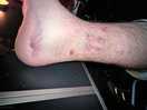My husbands leg after being kicked in the pool due to no supervision of unsafe behaviour from teens