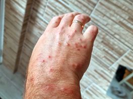 Bed bug bites