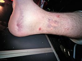 My husbands leg after being kicked in the pool due to no supervision of unsafe behaviour from teens