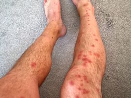 Bites