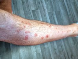 Bed bugs bites